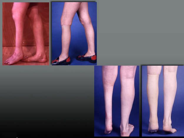 Leg external cosmetic prosthesis Leg PHP aesthetic prostheses