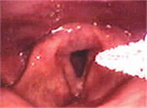 Laryngeal biopsy brush swab EndoCDx® LP CDx Diagnostics