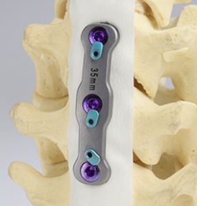 Cervical arthrodesis plate / anterior / 2 levels Simplicity® SOLO Precision Spine
