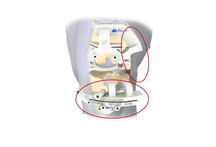 Knee prosthesis resection guide My Knee MIS Medacta