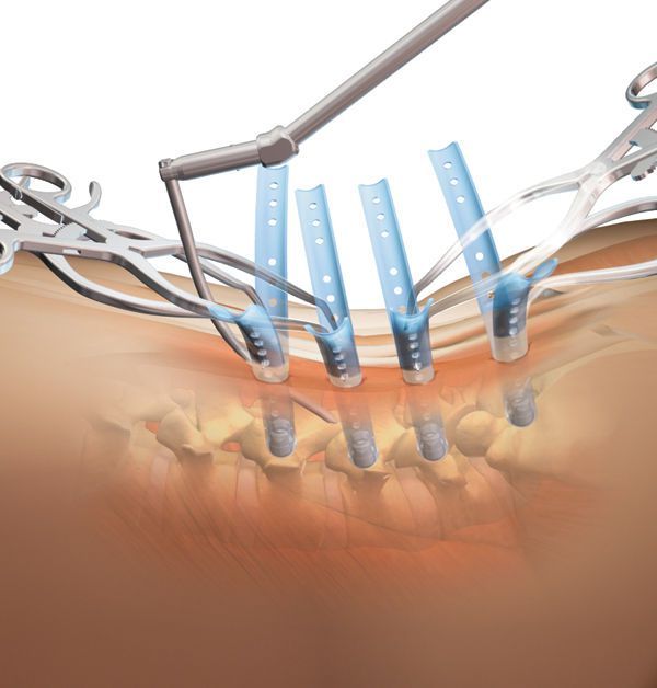 Orthopedic surgery retractor / for minimally invasive surgery / spine SERENGETI® K2M