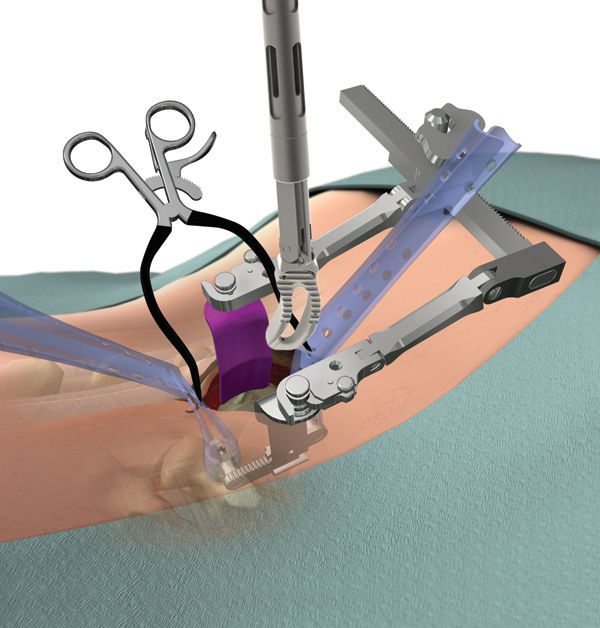 Minimally invasive surgery retractor / orthopedic surgery / spine TERRA NOVA® K2M