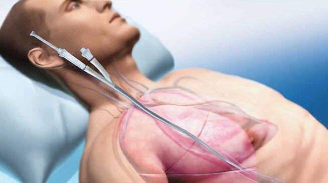 Infusion catheter / drainage / venous / double-lumen AVALON ELITE® MAQUET