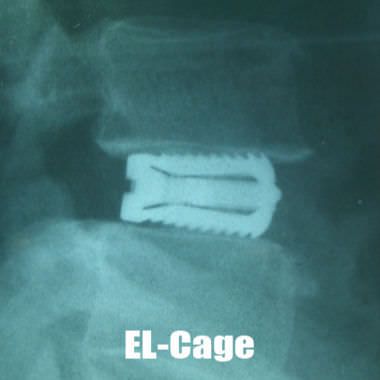 Lumbar interbody fusion cage EL-Cage TAEYEON Medical