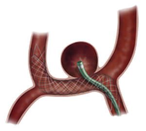 Peripheral stent / nitinol / self-expanding LVIS™ Jr. MicroVention