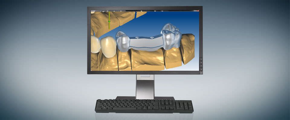 CAM software / CAD / for dental prosthesis design / medical Ceramill® m-bars Amann Girrbach AG