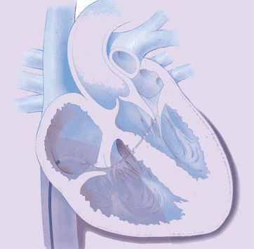 Diagnostic catheter / intracardiac Polaris X™ Boston Scientific