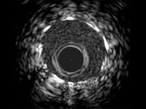 Imaging catheter / coronary / hydrophilic 40 MHz | iCross™ Boston Scientific