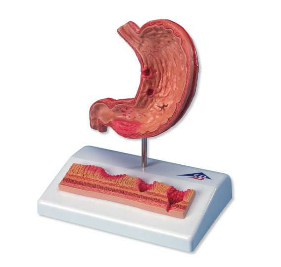 Stomach pathology anatomical model K17 3B Scientific