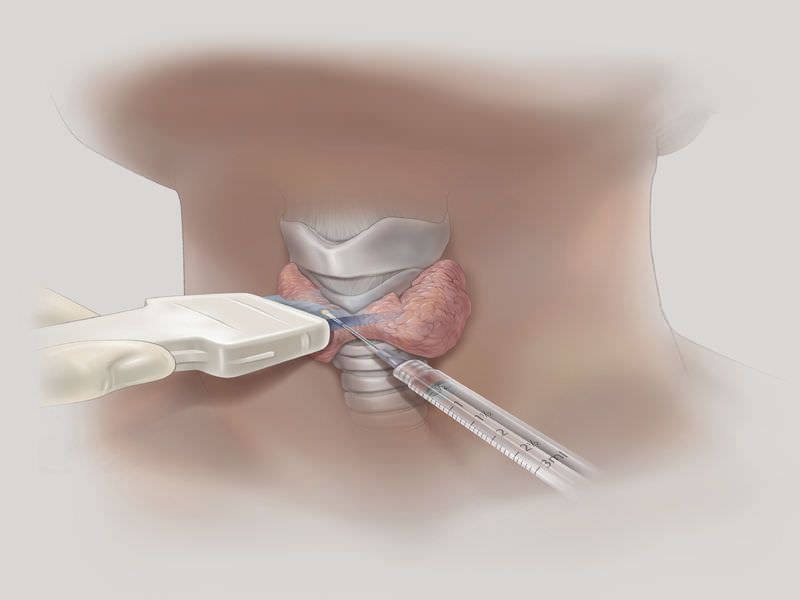 Biopsy needle / ultrasound-guided Chiba Echotip® COOK Medical