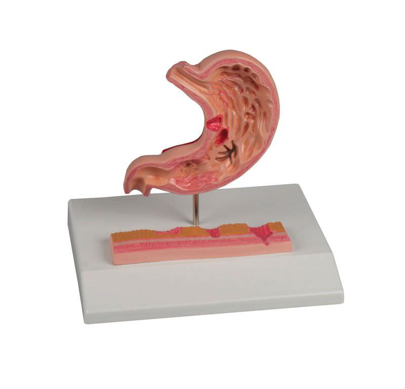 Stomach pathology anatomical model K217 Erler-Zimmer Anatomiemodelle