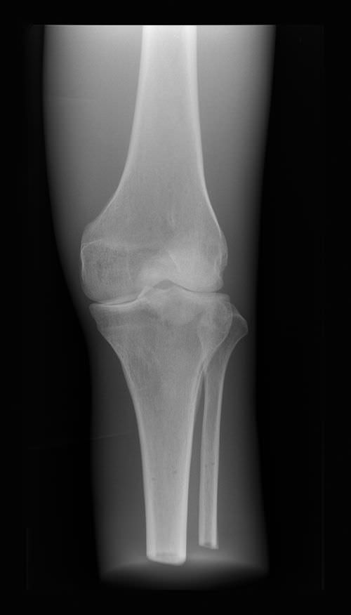 Radiography test phantom / knee 7250 Erler-Zimmer Anatomiemodelle