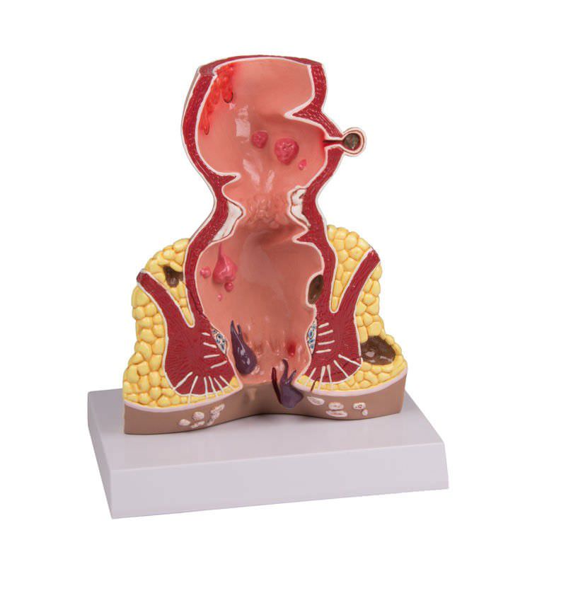 Rectum pathology anatomical model K90 Erler-Zimmer Anatomiemodelle