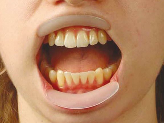 Dental retractor / mouth / lip Spandex® -Vertical Hager & Werken GmbH & Co. KG