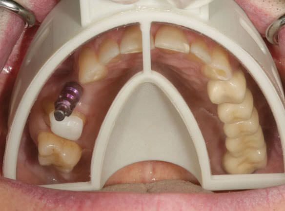 Dental impression tray Miratray® Implant Hager & Werken GmbH & Co. KG