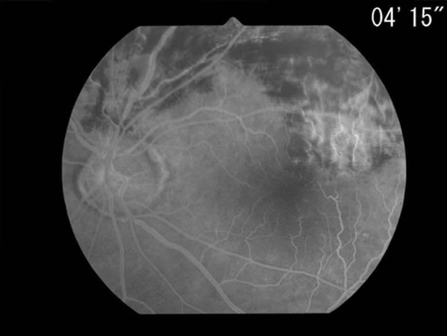 Mydriatic retinal camera (ophthalmic examination) / eye fluorescein angiography / hand-held Genesis-Df Kowa American Corporation