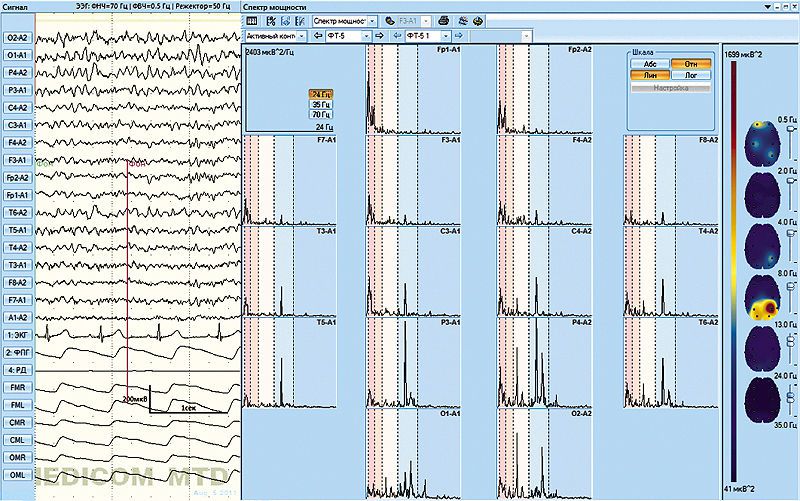 EEG software / medical Encephalan-EEGA Medicom MTD