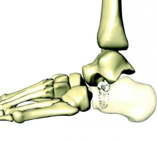 Talo-calcaneal ligament suture anchor / absorbable RSB CALCANEO STOP Lima Corporate