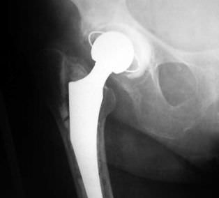 Revision acetabular prosthesis / cementless DELTA-REVISION TT Lima Corporate