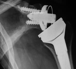 Inverted total shoulder prosthesis / traditional / cemented or non-cemented SMR REVERSE HP Lima Corporate