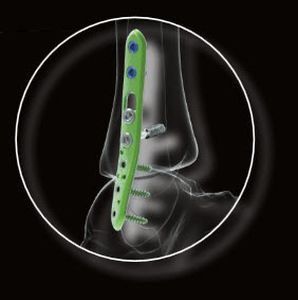 Fibula compression bone plate / distal Activ Ankle Newclip Technics