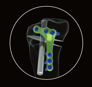 Tibia osteotomy plate / proximal ACTIVMOTION LIGAMENTO Newclip Technics