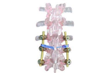 Cervico-thoraco-lumbo-sacral spinal osteosynthesis unit / posterior EVOLUTION PLUS Ortosintese