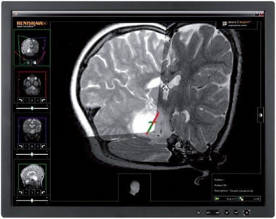 Preoperative planning software / for stereotactic neurosurgery / medical neuroinspire™ Renishaw