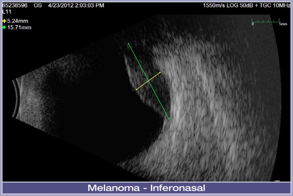 Ultrasound system / on platform, fixed / for ophthalmic ultrasound imaging Eye Cubed™ Ellex Medical