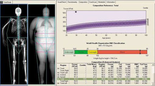 Data exchange software / analysis / for bone densitometry enCORE GE Healthcare