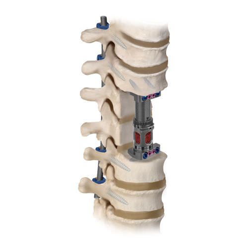 Thoraco-lumbar interbody fusion cage / lumbar / anterior / corpectomy FORTIFY®I Globus Medical