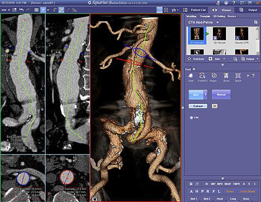Diagnostic software / 3D viewing / medical / medical imaging GORE® 3D Gore