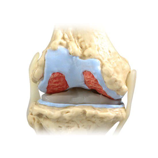 Knee pathology anatomical model / joints 1100 GPI Anatomicals