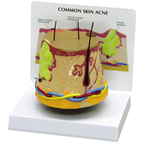 Skin pathology anatomical model 3750 GPI Anatomicals