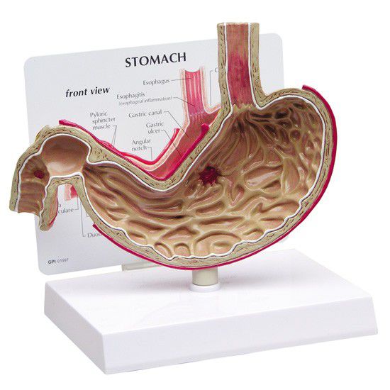 Stomach pathology anatomical model 2000 GPI Anatomicals