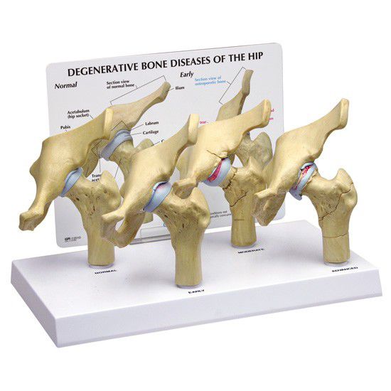 Joints pathology anatomical model / hip 1320 GPI Anatomicals