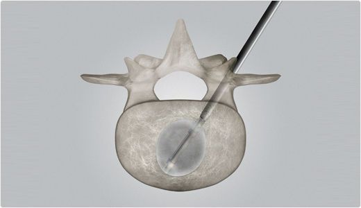 (vertebral fracture treatment) / percutaneous kyphoplasty balloon catheter AVAmax® CareFusion