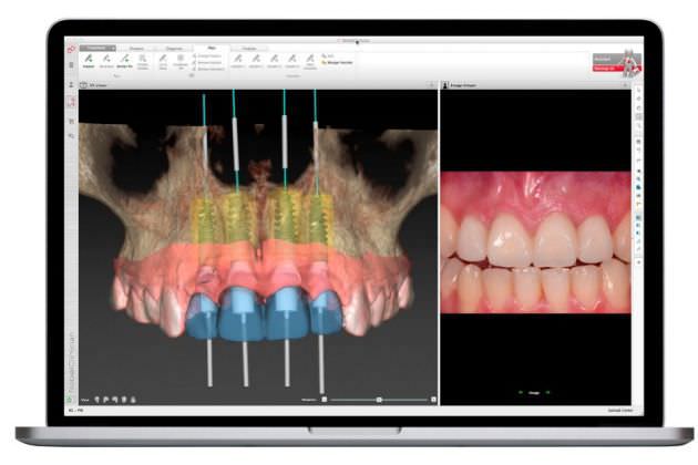 Dental implant simulation software / preoperative planning / for dental surgery / dentist office NobelGuide® Nobel Biocare Services AG