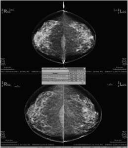 QUANTRA Breast Density Assessment Software